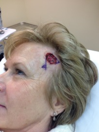 2014-03-05 10-57-27 Basal Cell Carcinoma surgery.jpg